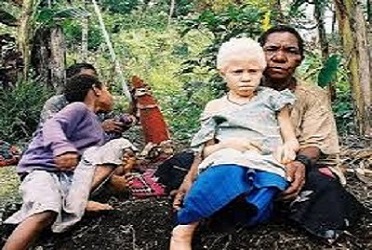 Black parents with albino child